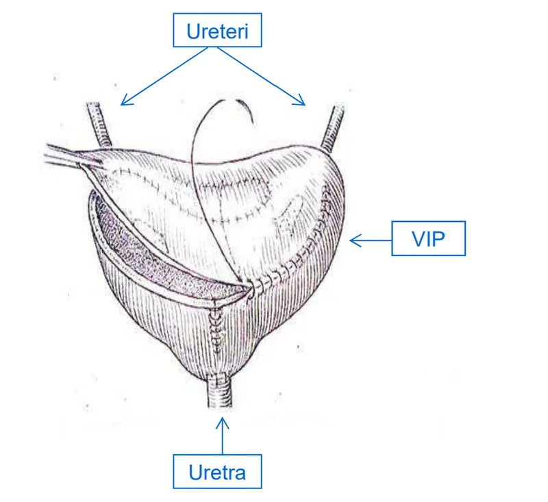 Diagram of the VIP: ureters, ileal reservoir, urethra
