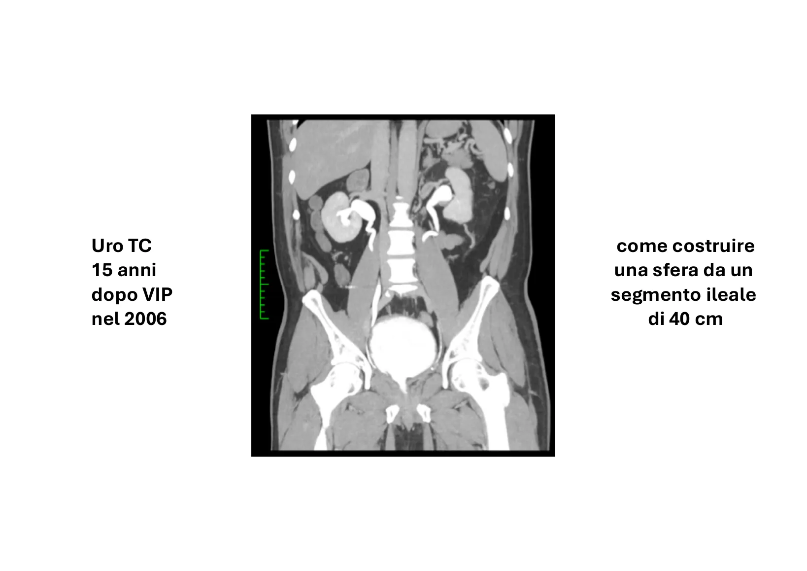 Page 12: CT urography 15 years later and the sphere made from 40 cm of ileum